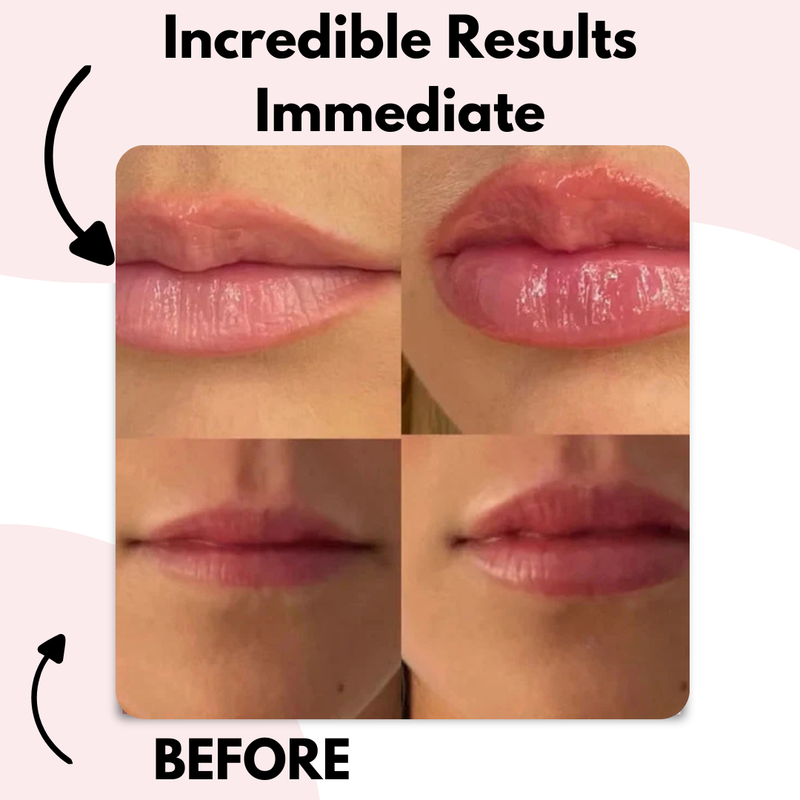 Lip Gizmo by Oveon - Immediate and Natural Lip Enhancement