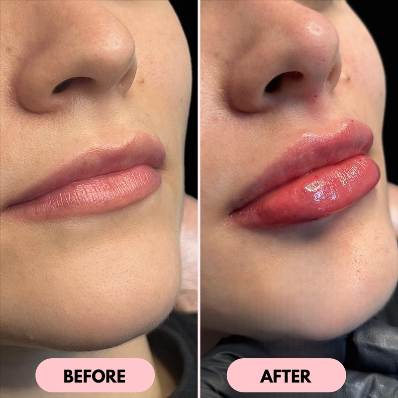 Lip Gizmo by Oveon - Immediate and Natural Lip Enhancement