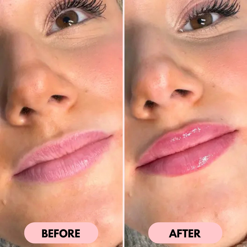 Lip Gizmo by Oveon - Immediate and Natural Lip Enhancement